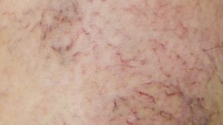 あなたの身体に「細絡」出現していませんか？細絡は身体からのSOS！！